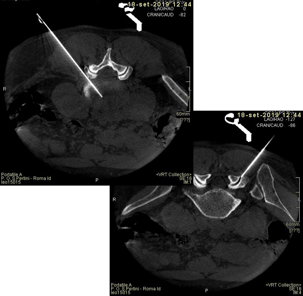 Insufflazione Rettale